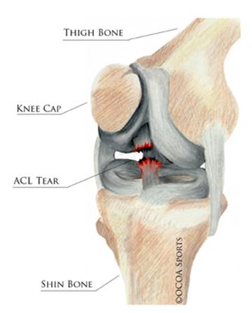 ACL Tears Can Be Repaired (Sometimes) – Nirschl Orthopaedic Center