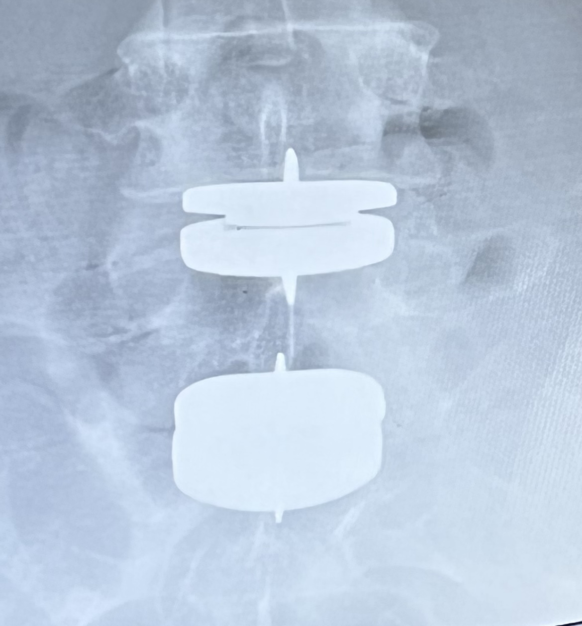 Spinal Cord Stimulation - Barry F. Faust Jr., MD: Interventional Pain  Medicine Metairie, LA: Faust Interventional Pain